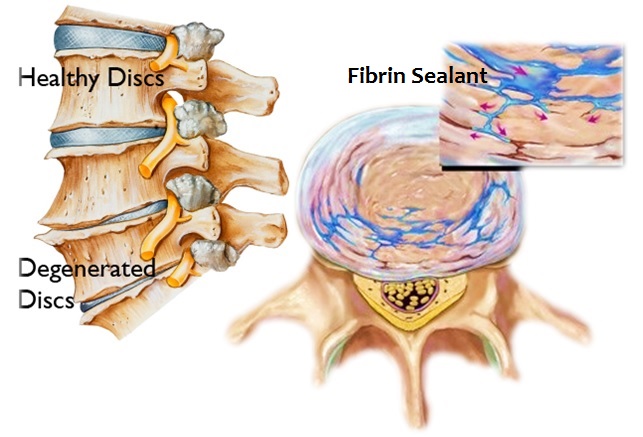 Spine Degenerative Discs